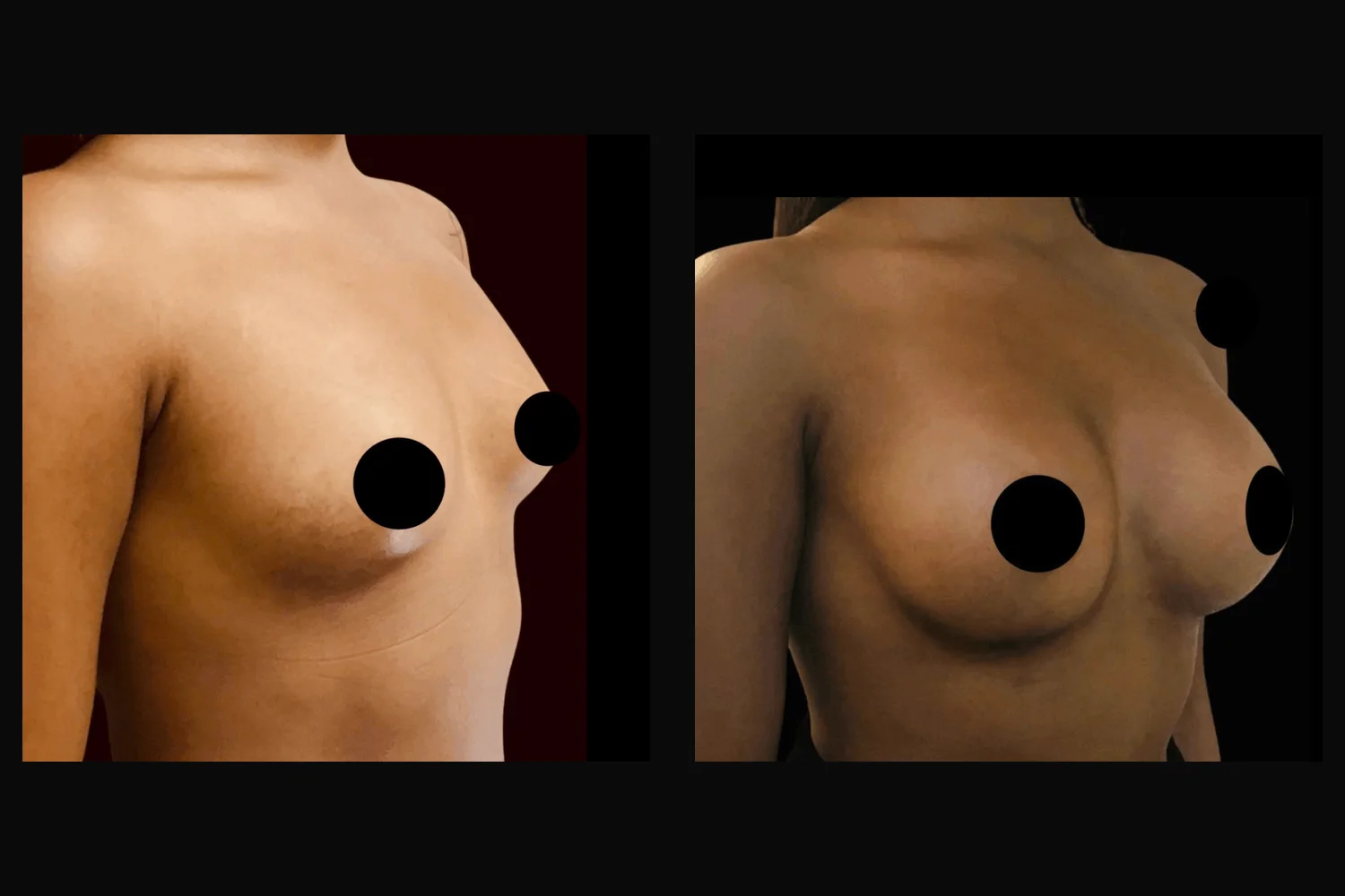 Breast augmentation