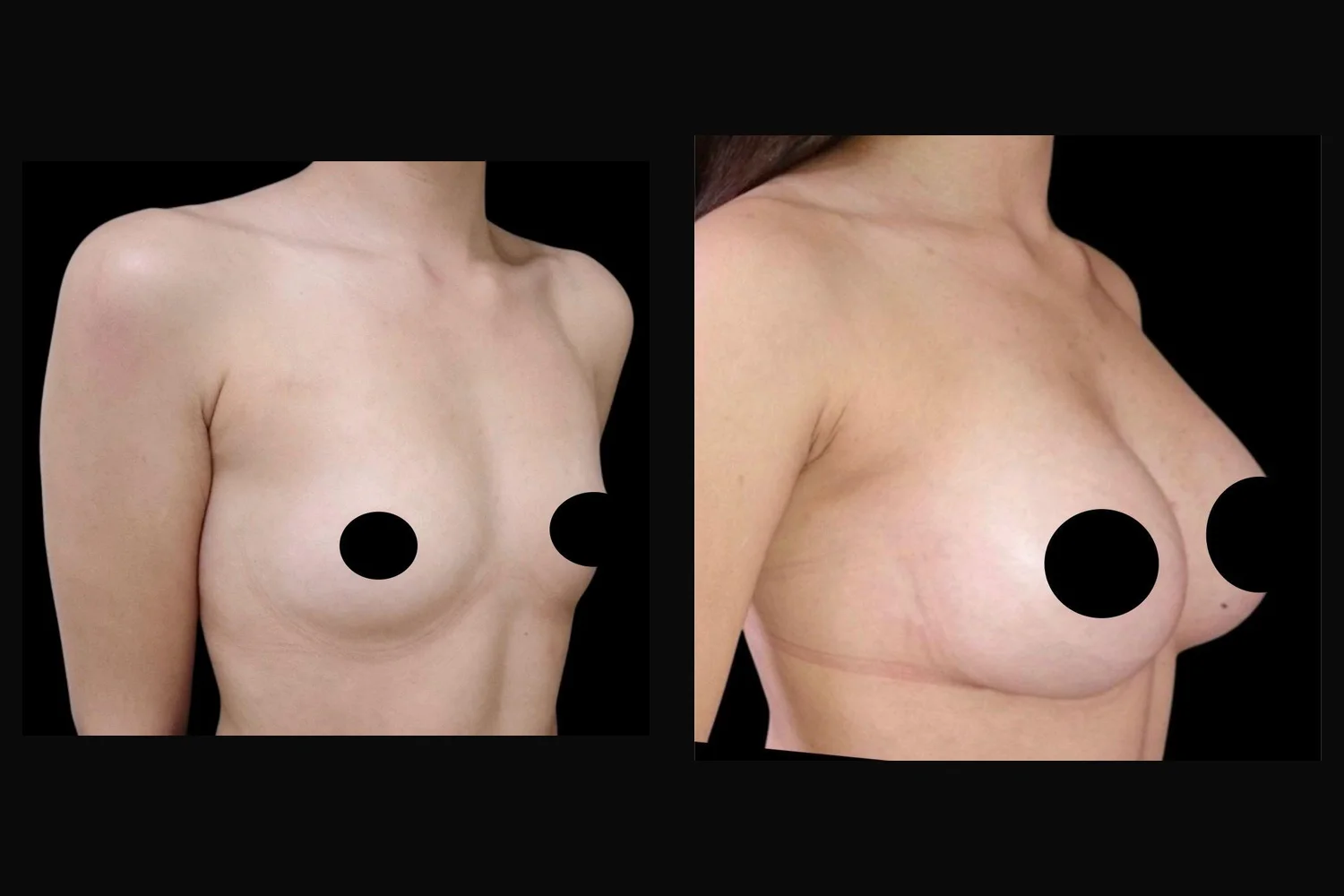 Breast augmentation