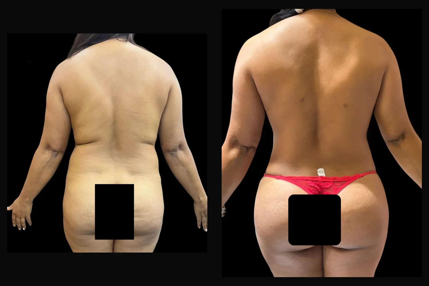 Brazilian Butt Lift (BBL)