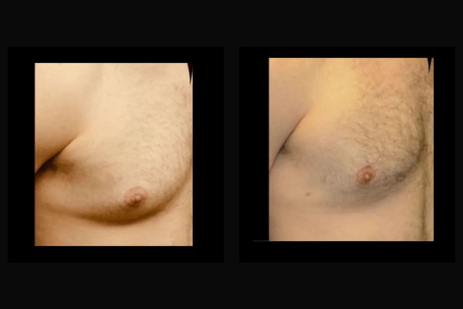 Ginecomastia