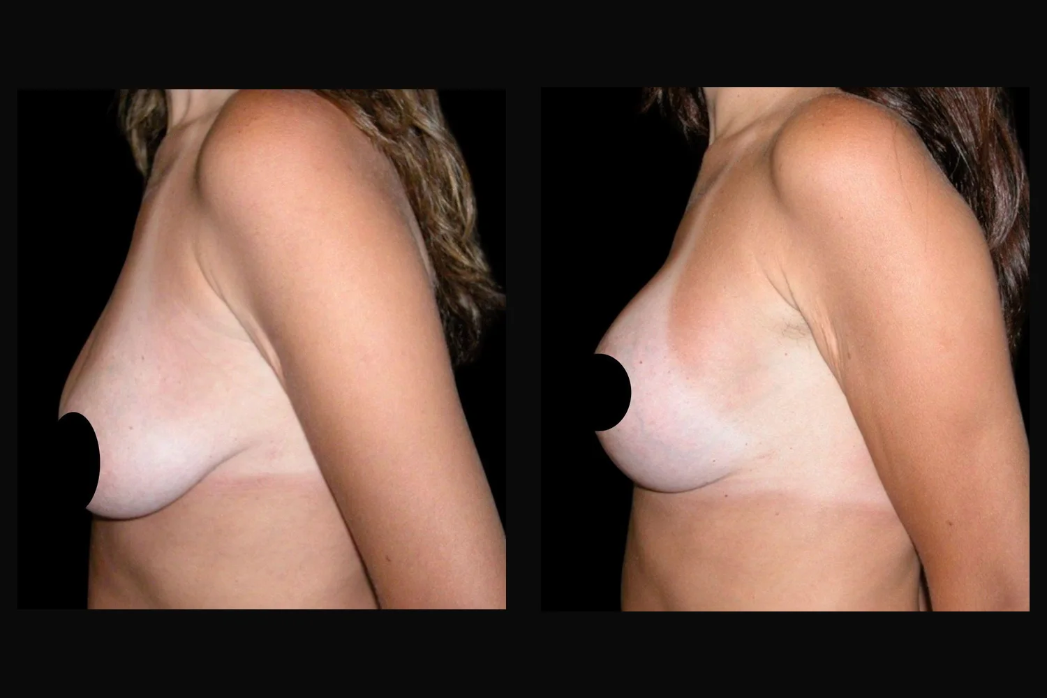 Breast lift