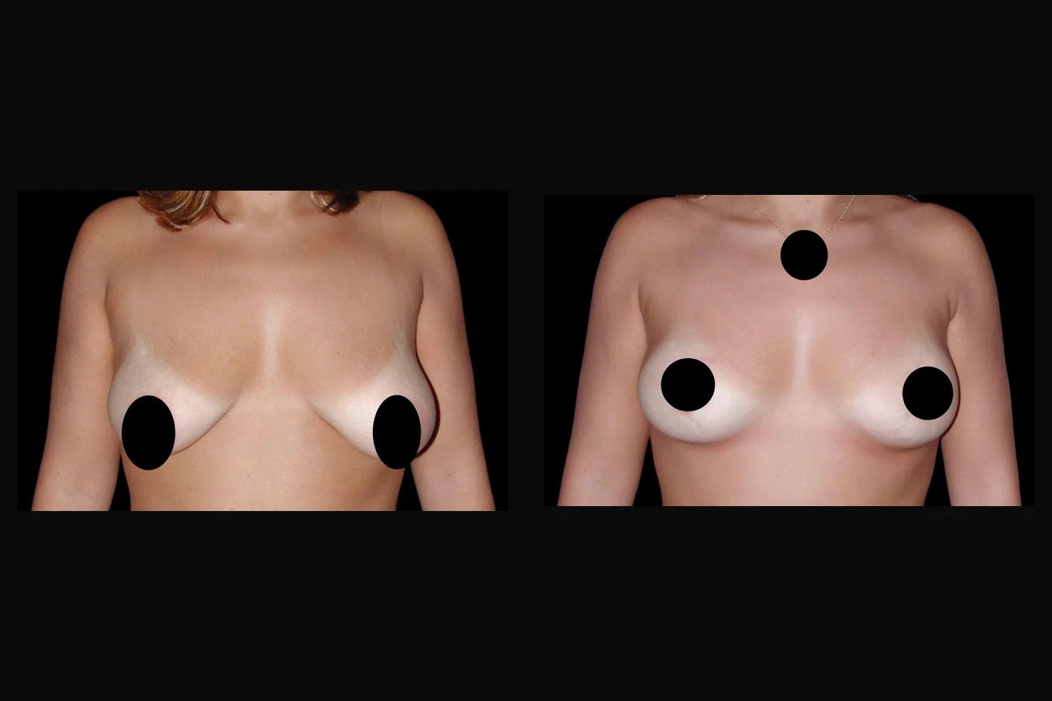 Breast lift